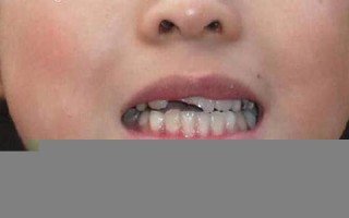 梦见掉门牙(梦见掉门牙是什么预兆 女性)